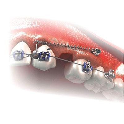 MINI PARAFUSO BRAQ. HORARIO 8MM MORELLI